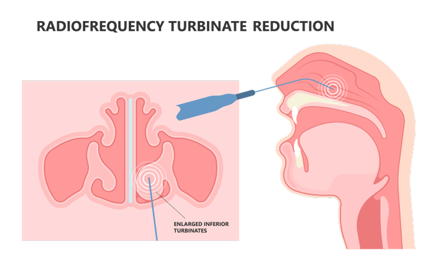 Radiofrequency turbinate reduction