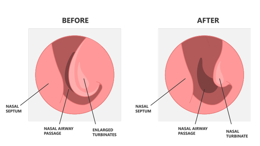 Before and after coblation showing nasal airway passage