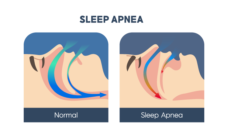 Illustration of normal airway vs airway during sleep apnea