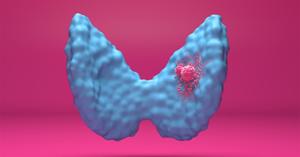 Image of thyroid in blue on pink background. Cancer tumor shown in pink.