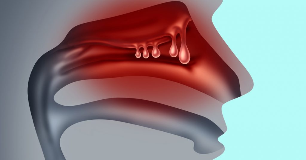 Illustration of nasal polyps