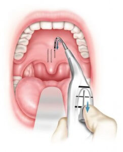 pillar-insertion