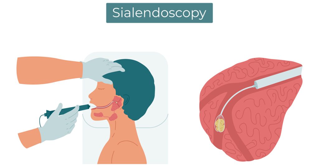 sialendoscopy Sialendoscopy illustration