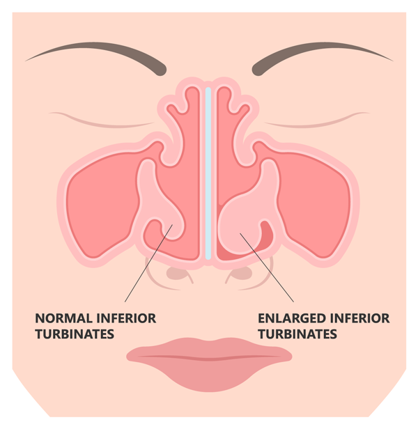 Normal vs enlarged inferior turdinates